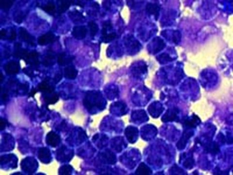 High magnification revealed a malignant lymphoid cell infiltrate compatible with a recurrence of ALL..