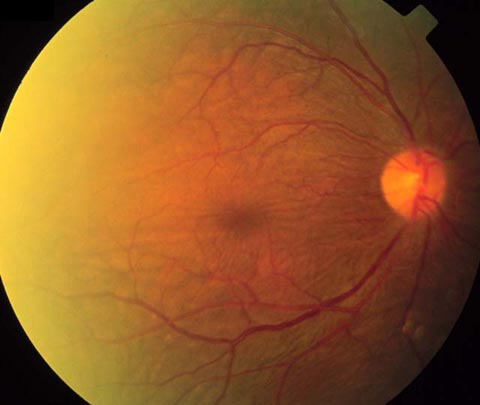 Ophthalmoscopy posterior pole, right eye, showing macular striae and choroidal folds.