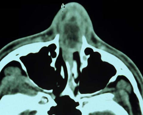 CT scan showing an area of soft tissue swelling in the nasal septum.