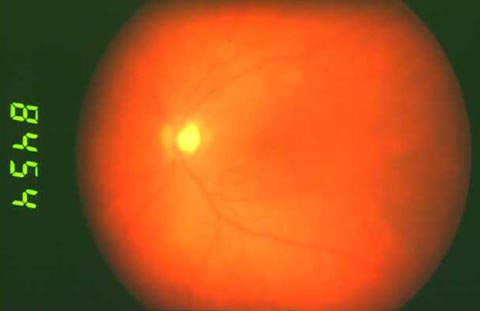 Fundus photo of the patient's left eye.