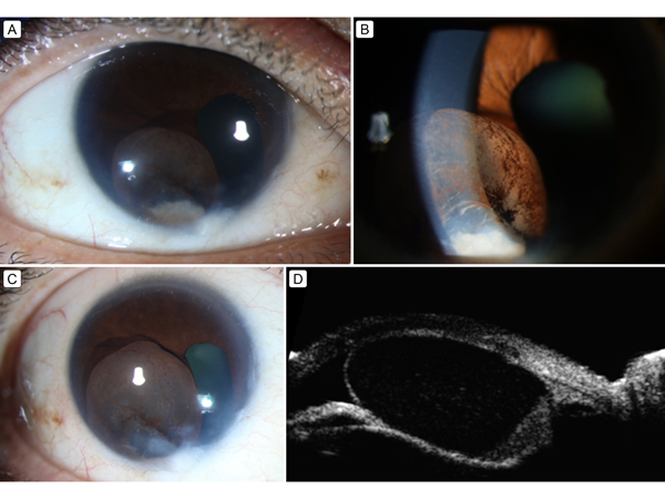 Figure 3. A-B, Anterior segment photographs of the right eye taken 5 months after initial presentation showing reformed large translucent iris cyst inferiorly, blocking the visual axis, with proteinaceous material floating within the cystic structure. C, Anterior segment photograph of the right eye 6 months after presentation showing increase in size of reformed large translucent iris cyst inferiorly, blocking the visual axis, with proteinaceous material within the cystic structure. D, UBM of the right eye 6 months after presentation showing inclusion cyst with posterior bulge against the lens.