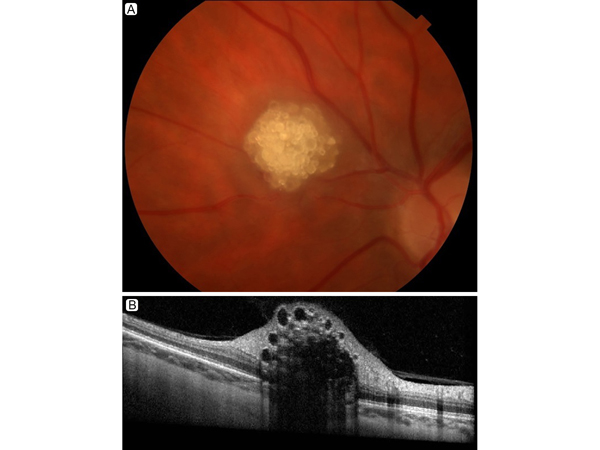 Solitary retinal astrocytic hamartoma