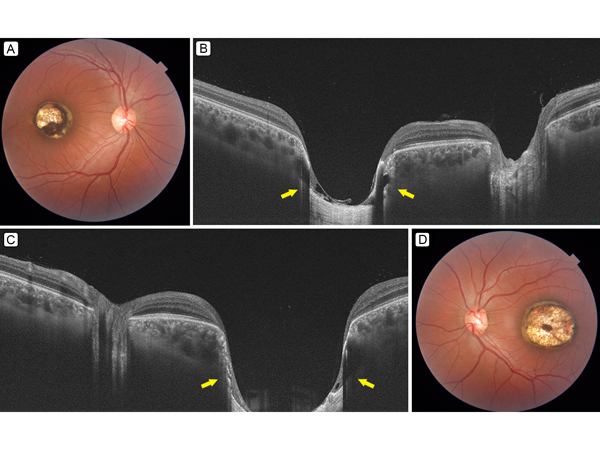 Swept source optical coherence tomography imaging in macular coloboma