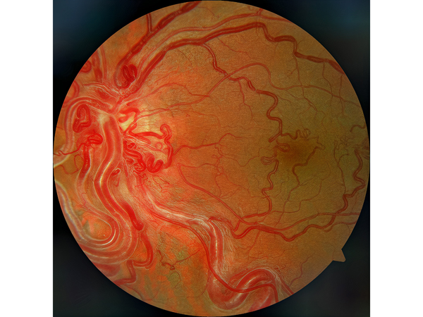Wyburn-Mason syndrome is a rare, nonhereditary disorder in which vascular dysgenesis affects the retina and brain. It is characterized by the presence of AVMs that vary in size and location.