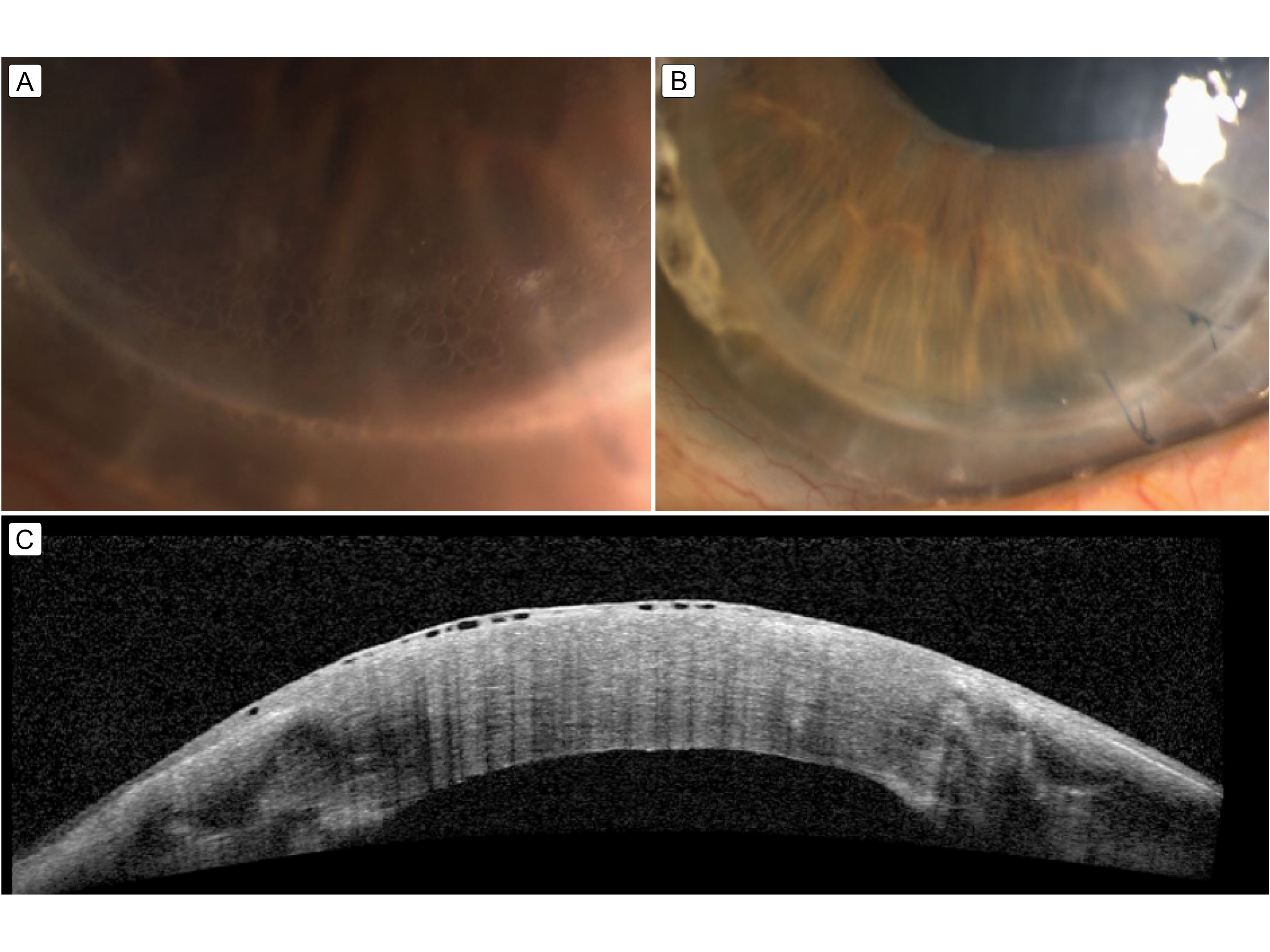 Slit lamp photograph of the left eye showing cystic reticular epithelial change over the inferior border of the penetrating keratoplasty after initiation of netarsudil. B, Anterior segment optical coherence tomography shows intraepithelial cystic changes. C, Four months after initial presentation and discontinuation of netarsudil, the reticular epitheliopathy appeared resolved.