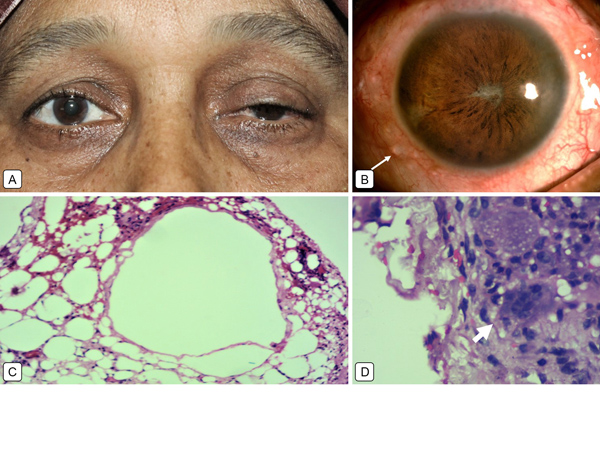 Chronic granulomatous inflammation in subconjunctival silicone oil cyst