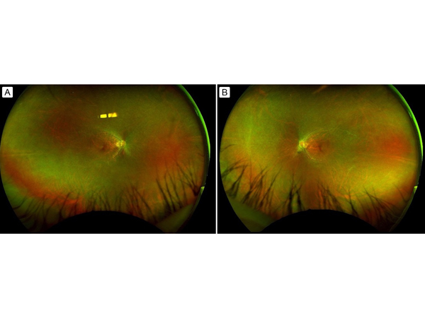 Dilated fundus examination showing attenuated vascularity huddled around the macula in the right eye (A) and left eye (B).