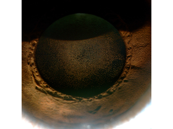 Tiny, stellate, brown pigmented flecks (“epicapsular stars”) on the anterior lens capsule partially obstructing the pupillary axis.