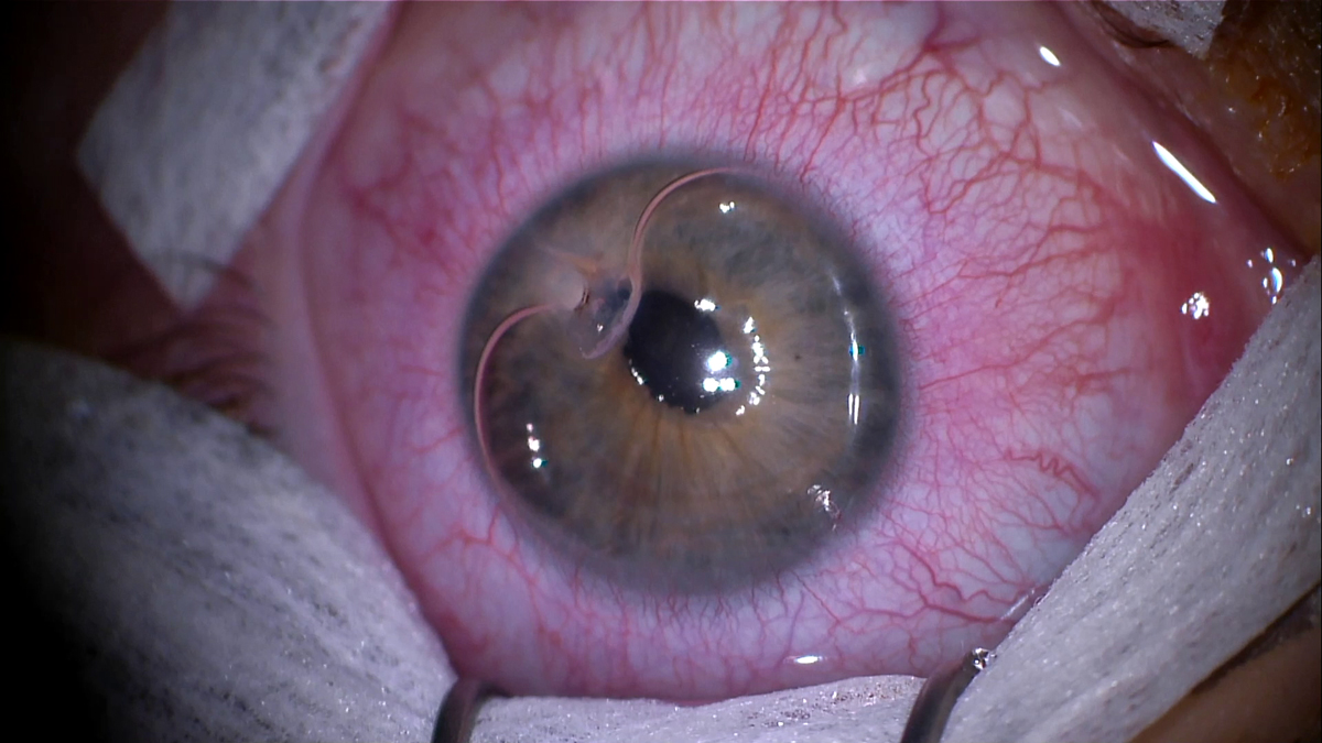 Snapshot from ocular trauma repair video