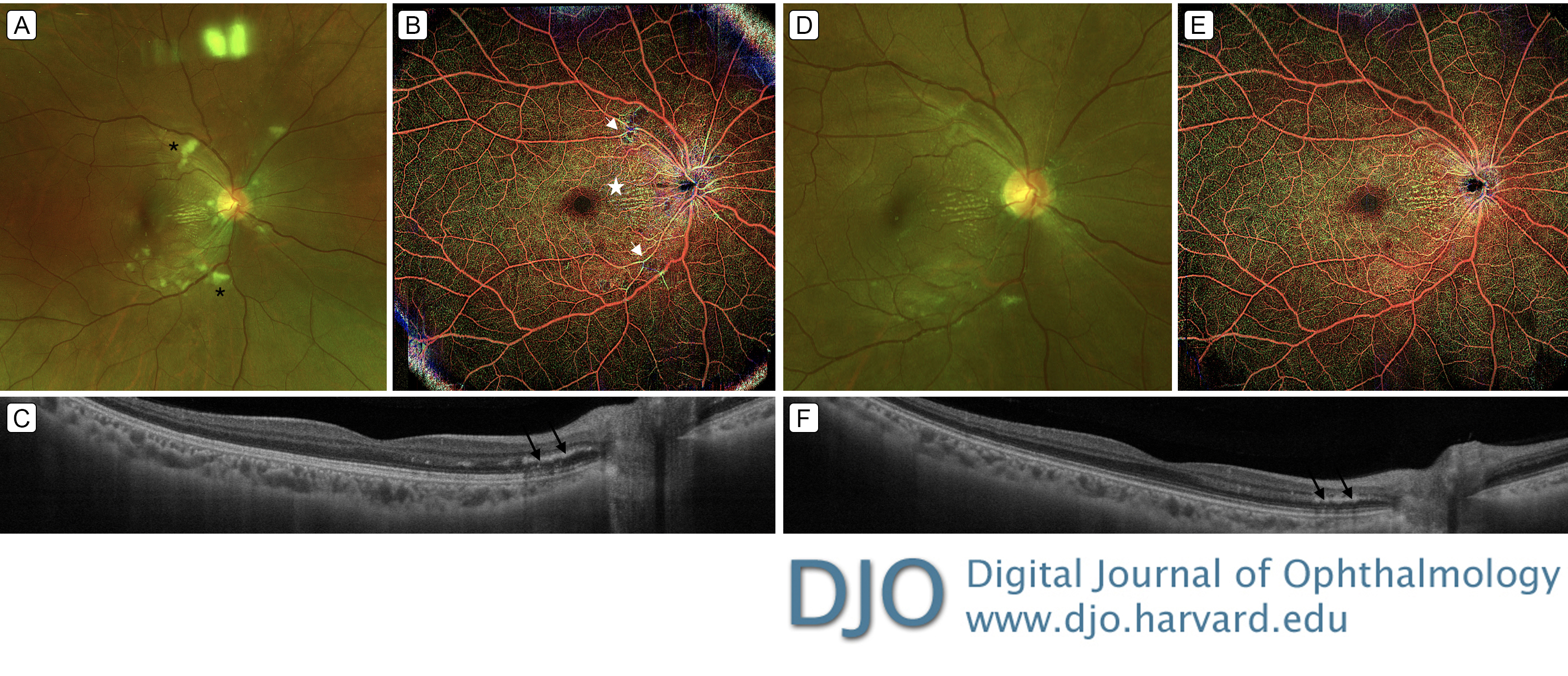 Wide-field swept source optical coherence tomography angiography: a noninvasive tool for the assessment of retinal changes associated with hypertensive emergency