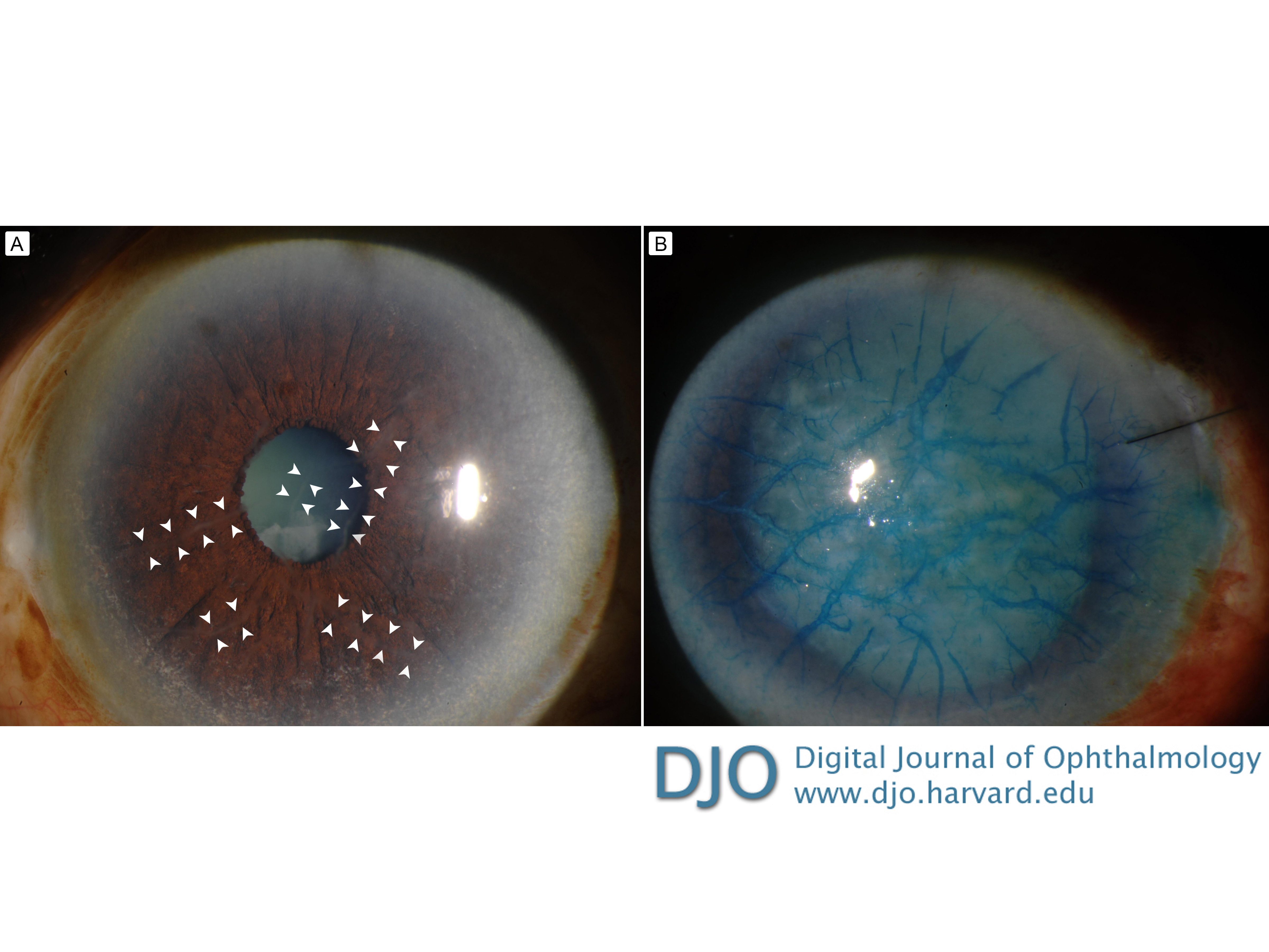 Lattice corneal dystrophy