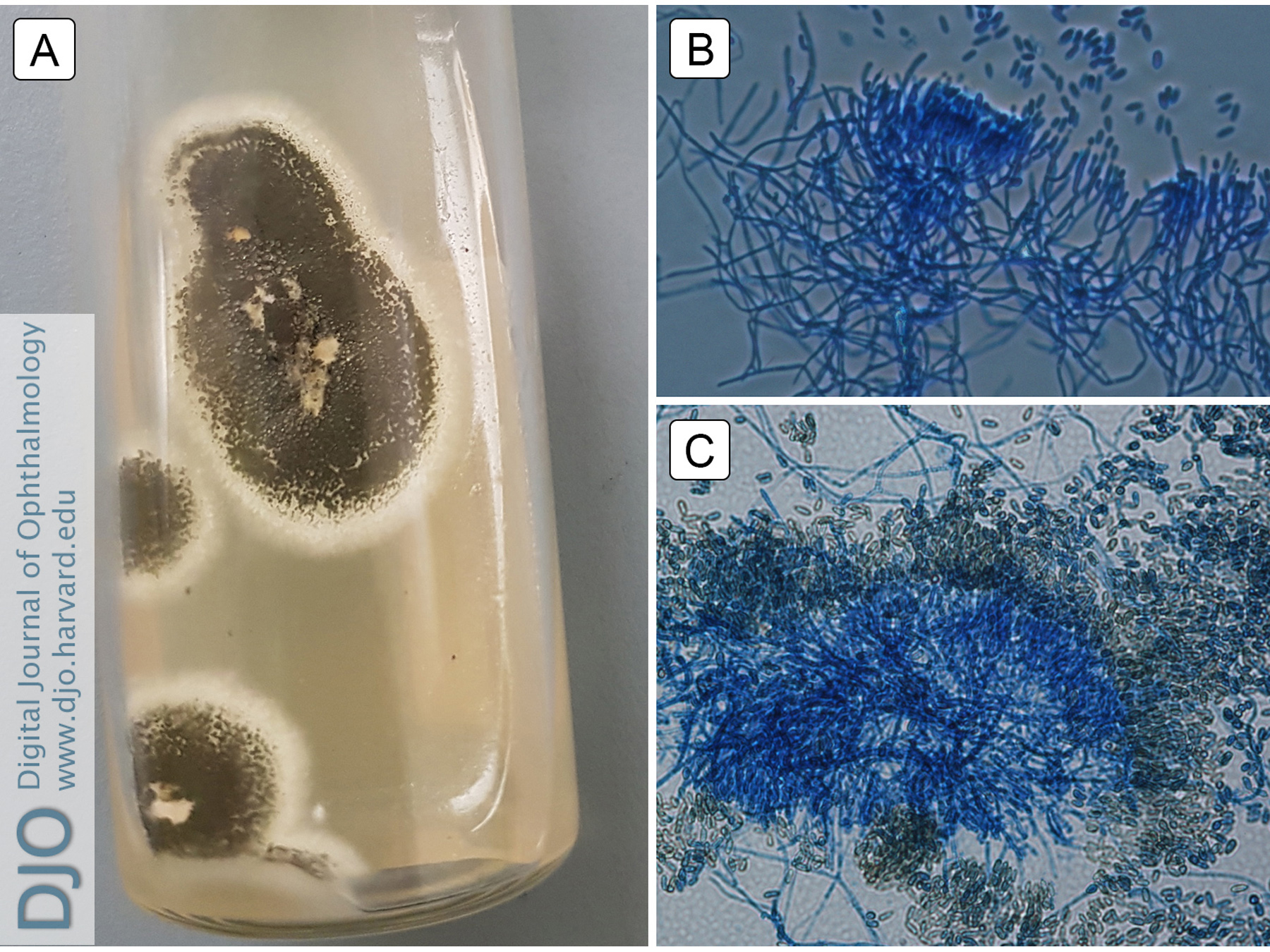 Metarhizium anisopliae strain isolated in the present case. A, Olivaceous-green colonies grown on potato dextrose agar at 25° C for 10 days. B, Specialized fungal stalks (conidiophores) aggregated in dense tufts with verticillate branching. C, Yellow-green cylindrical-shaped fungal spores (conidia), produced in long chains on conidiophores.