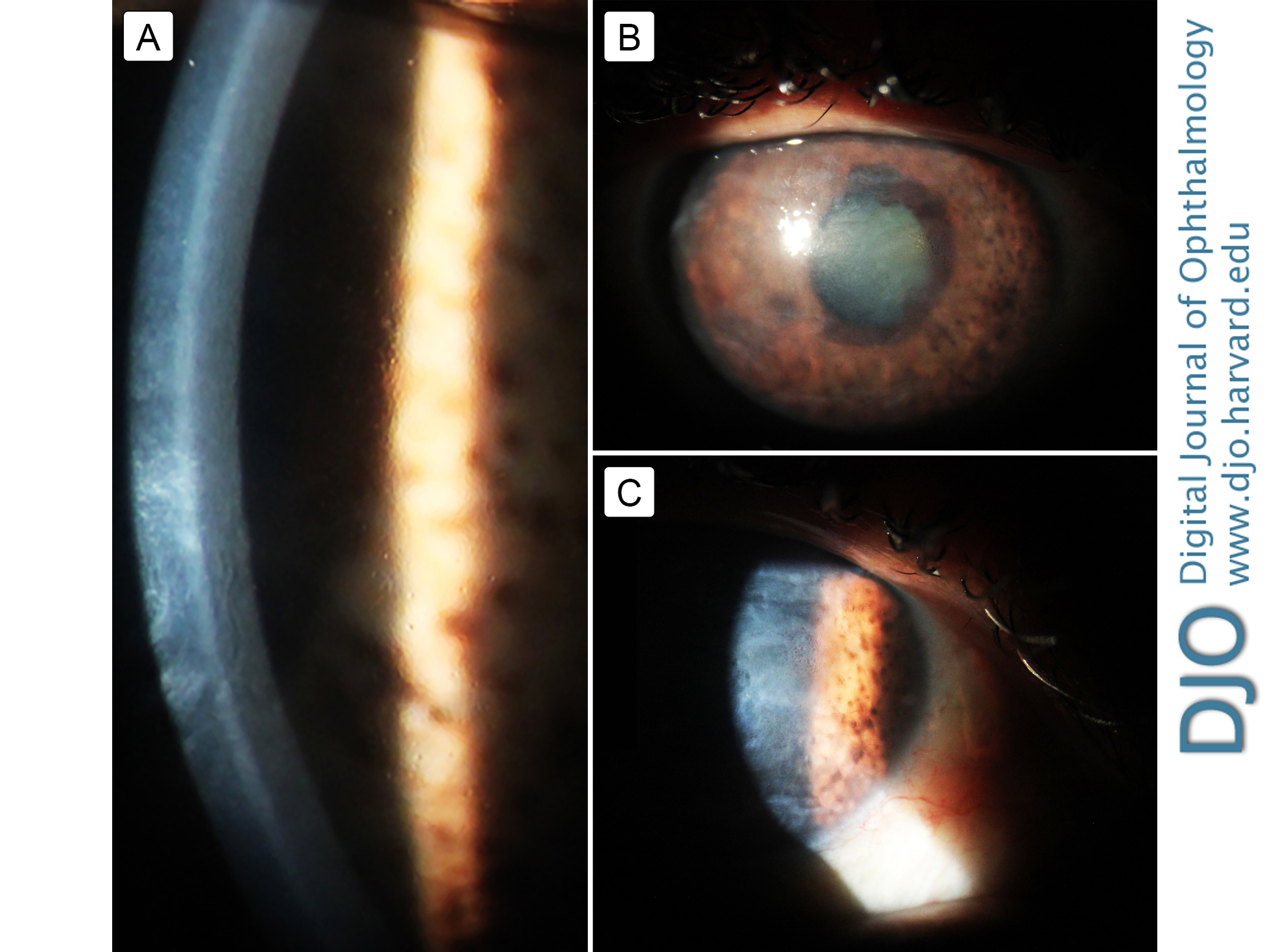 A, Slit-lamp biomicroscopy imaging of the cornea of this patient showing an irregular endothelium and mild stromal edema on presentation. B, The same cornea, 14 months later, with moderate stromal edema that reduces the visibility of iris details. C, Two years after presentation, the cornea shows marked stromal edema, hampering the direct view of the anterior segment.