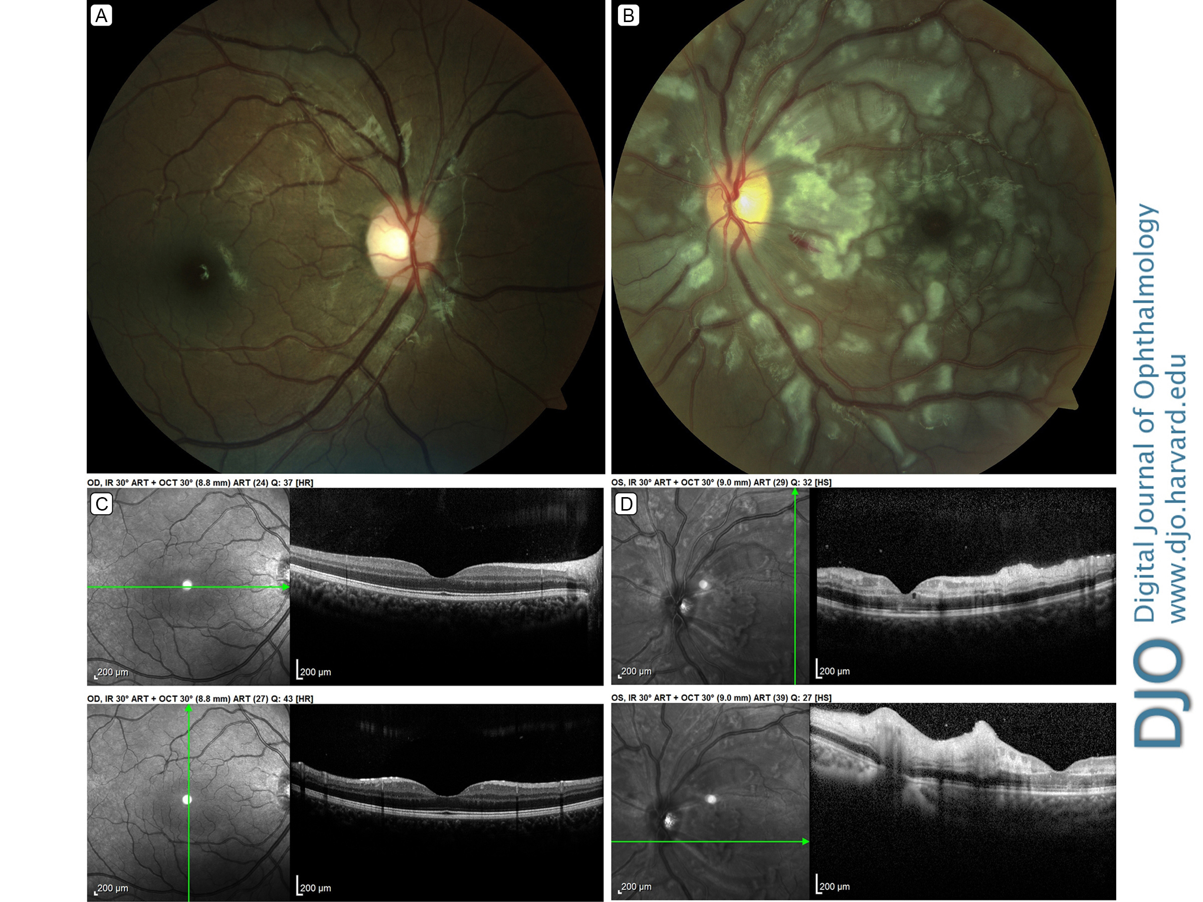 Purtscher retinopathy