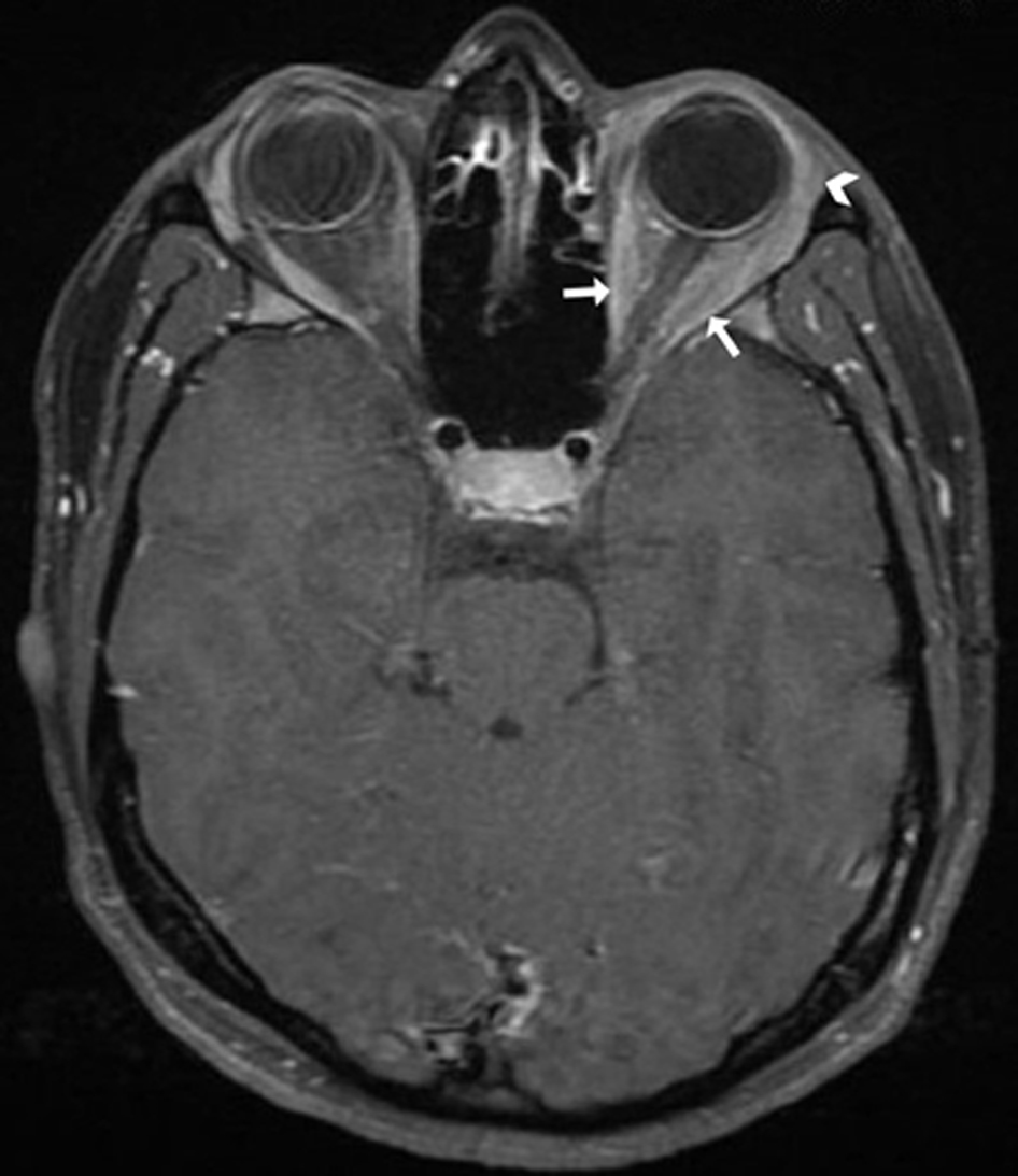 T1-weighted magnetic resonance image of the head and orbits with fat suppression and contrast. There is mild thickening of the left extraocular muscles (arrows) and left lacrimal gland (arrowhead), with abnormal enhancement of these structures and of the intraconal fat.