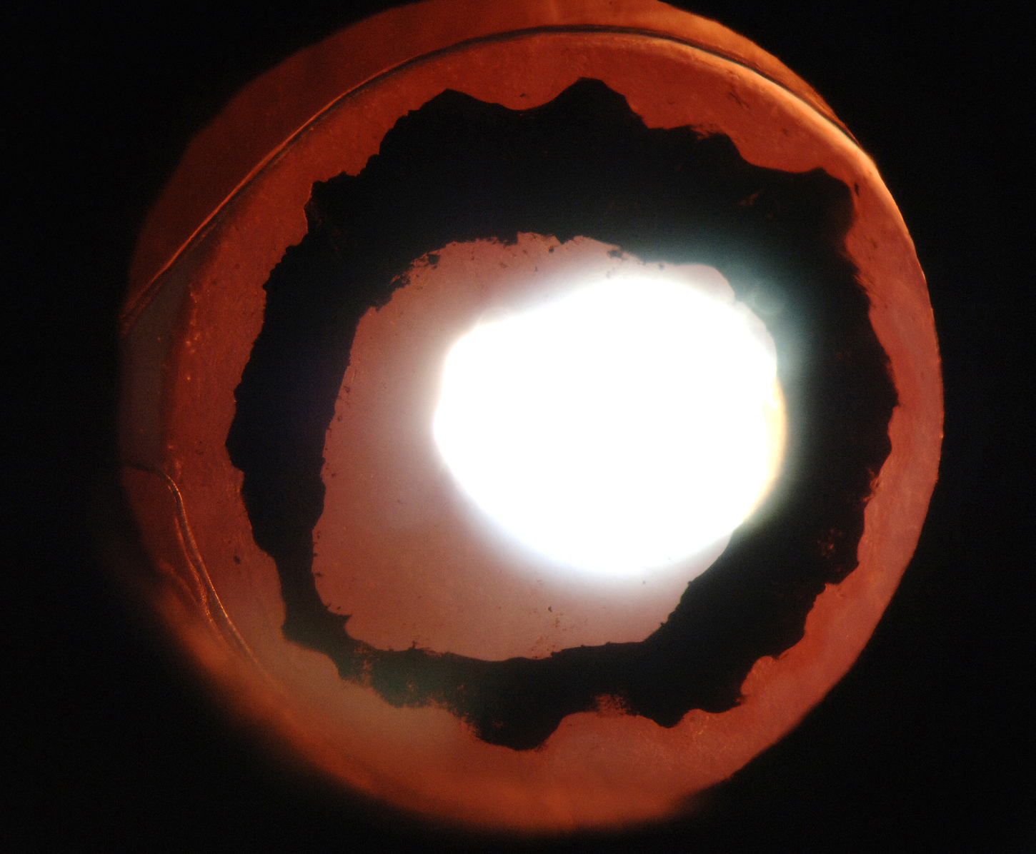 Pseudo-Vossius ring after Descemet stripping automated endothelial keratoplasty