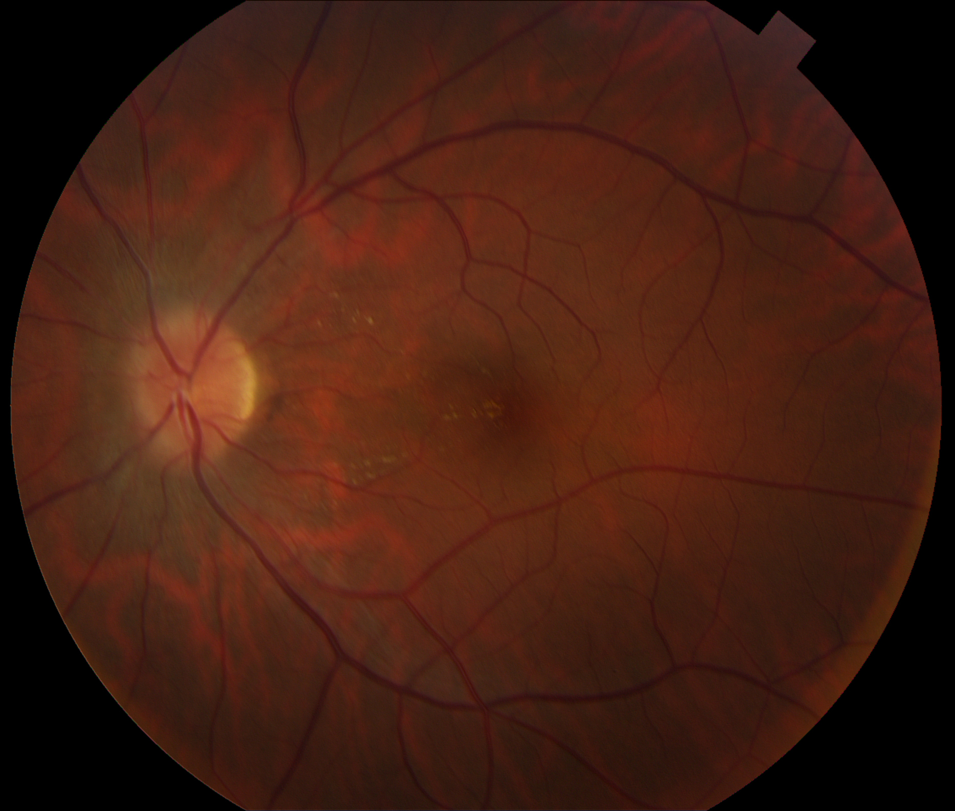 Fundus photograph of the left eye showing resolution in disc edema and macular star, with residual exudates in the nasal macula
