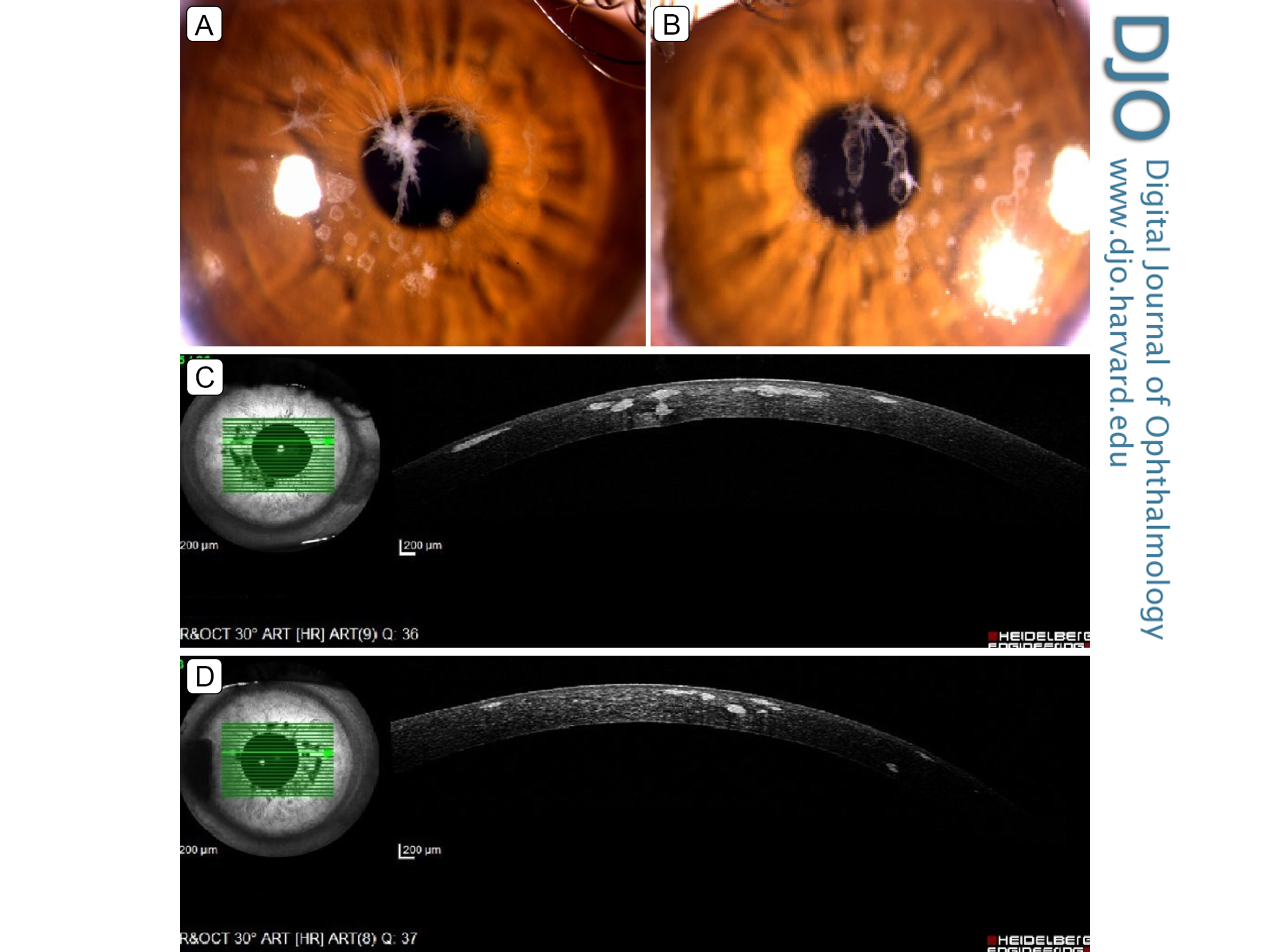 Avellino (combined granular-lattice corneal) dystrophy