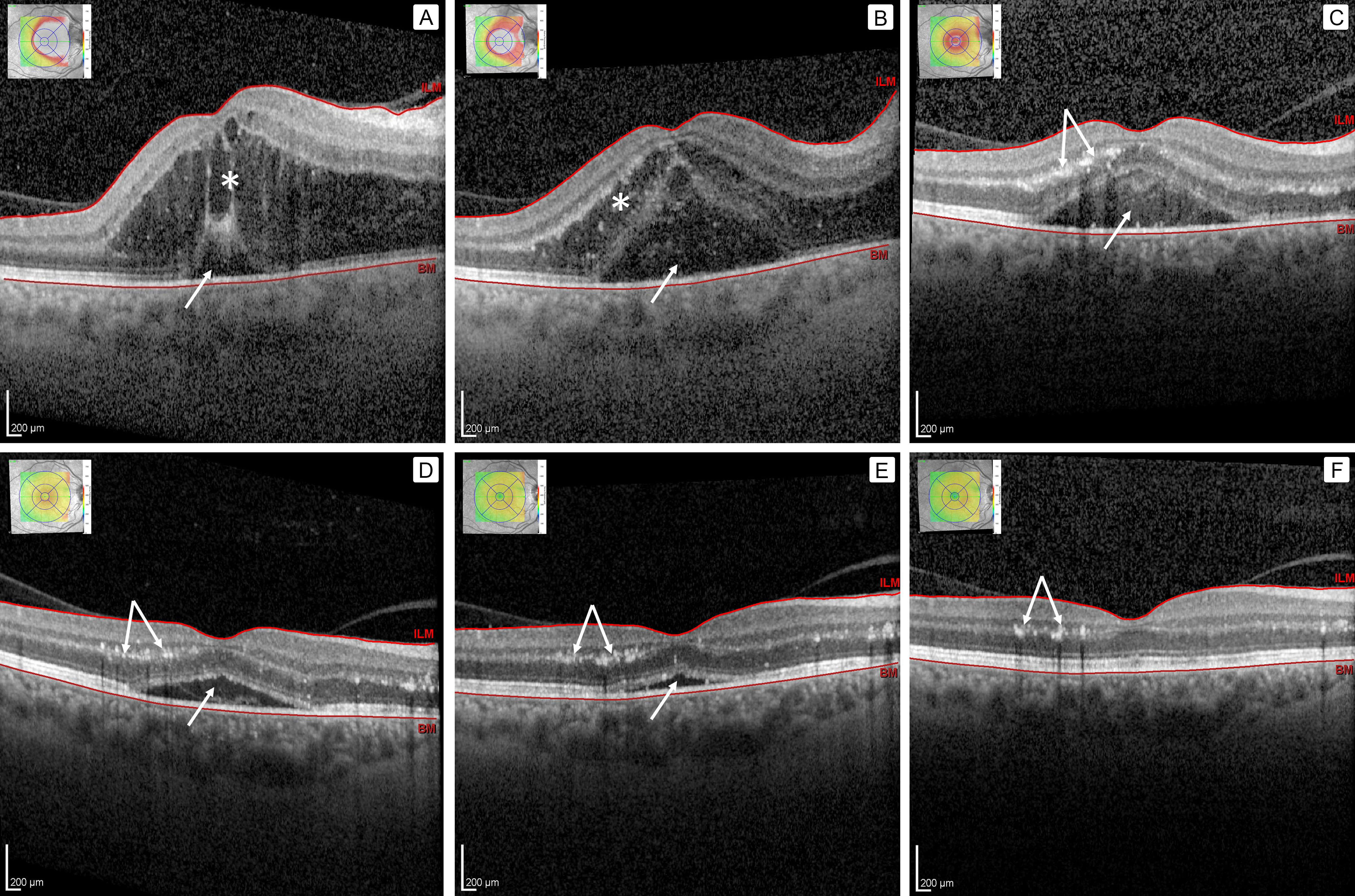 Optical coherence tomography series