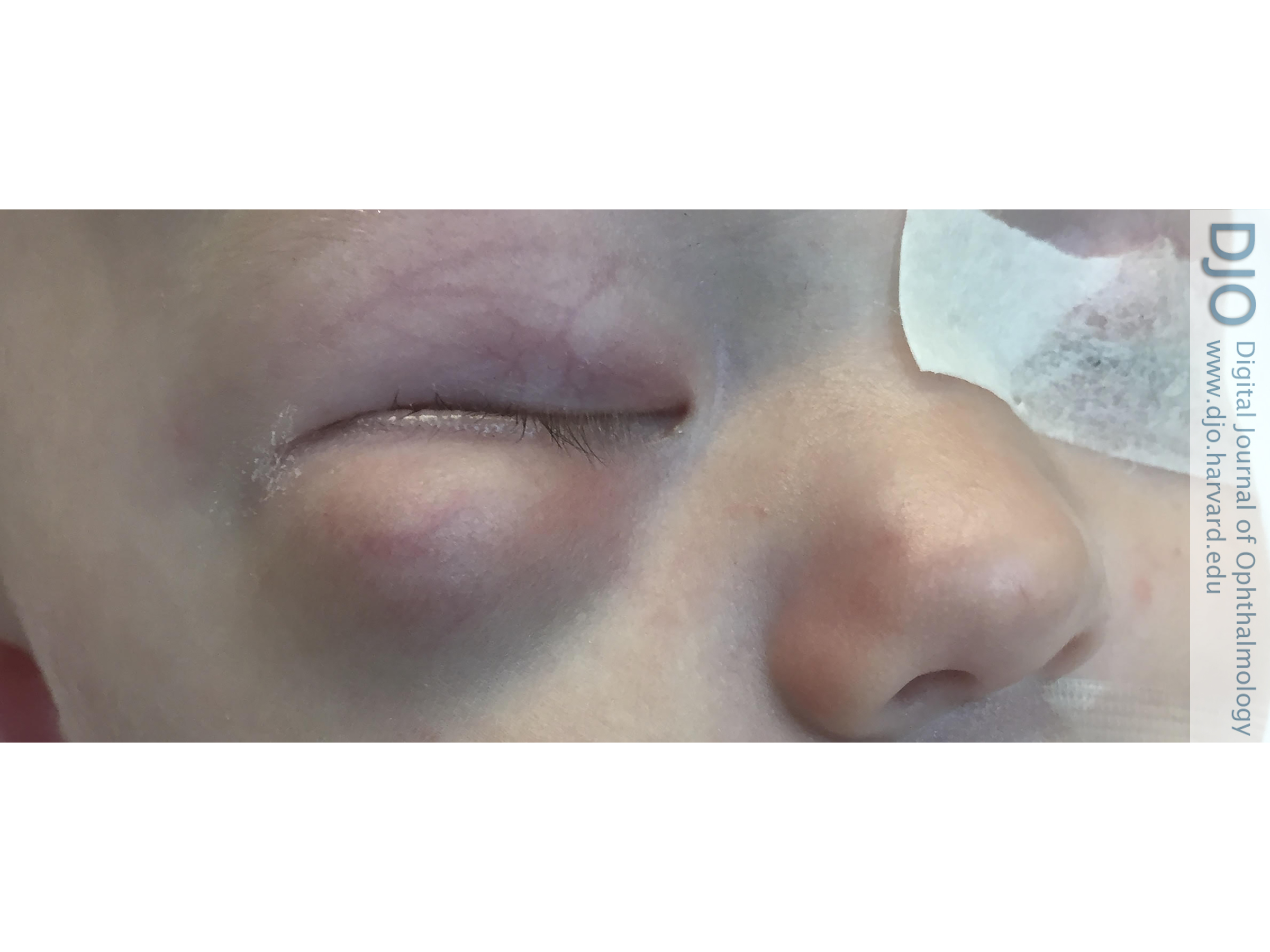 Orbital desmoplastic small round cell tumor in an infant