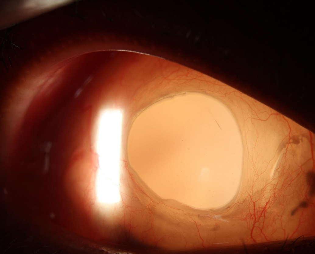 Cornea replaced by rigid gas permeable lens