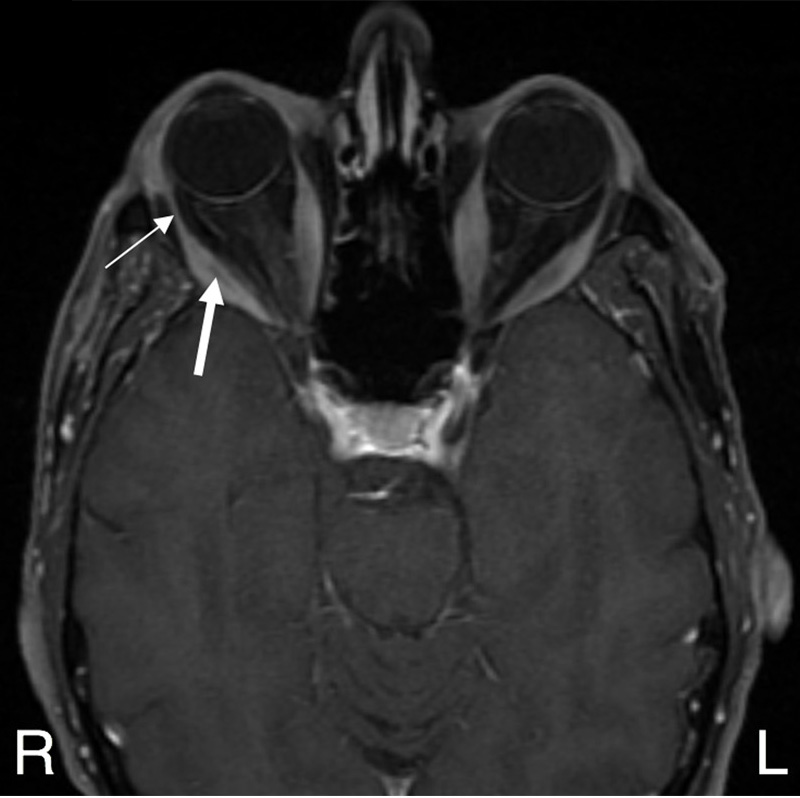 Extraocular muscle belly enlargement in thyroid-associated orbitopathy