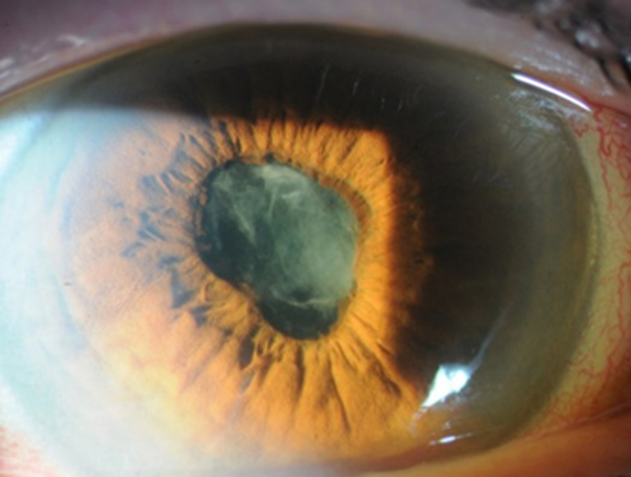 Slit-lamp photograph showing conjunctival injection, corneal edema with Descemet folds, fibrinous anterior chamber reaction in the pupil, and posterior synechiae with a pupillary membrane