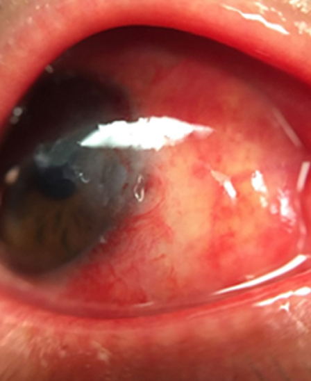 Experimental use of an extracellular matrix graft in pterygium surgery