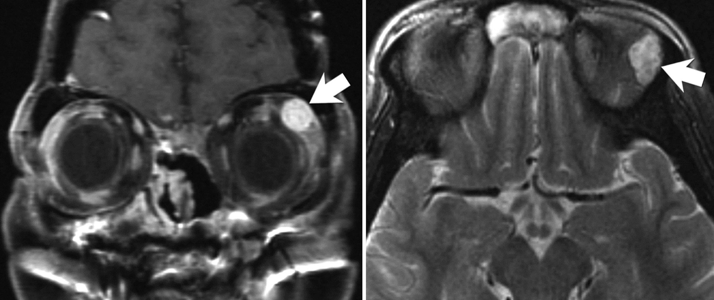 A 60-year-old woman with an asymptomatic left lacrimal gland mass found incidentally