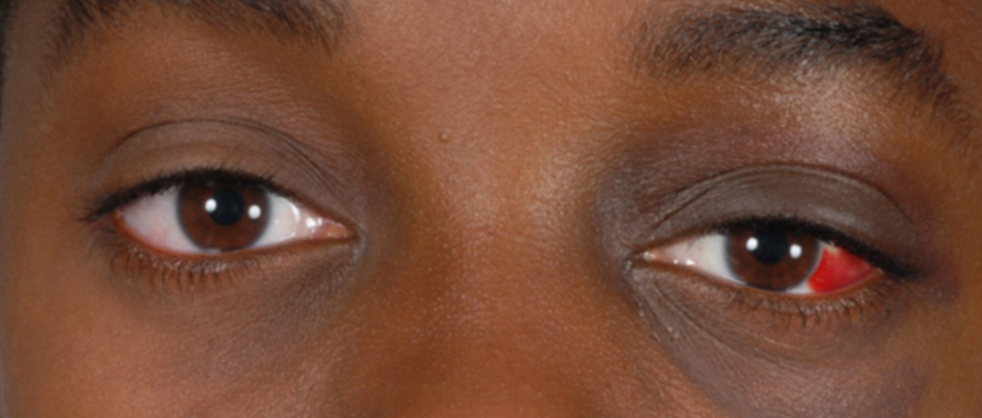 A 15-year-old-boy with an optic neuropathy