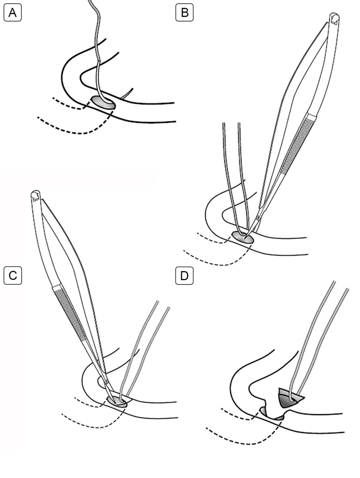 Suture-assisted punctoplasty