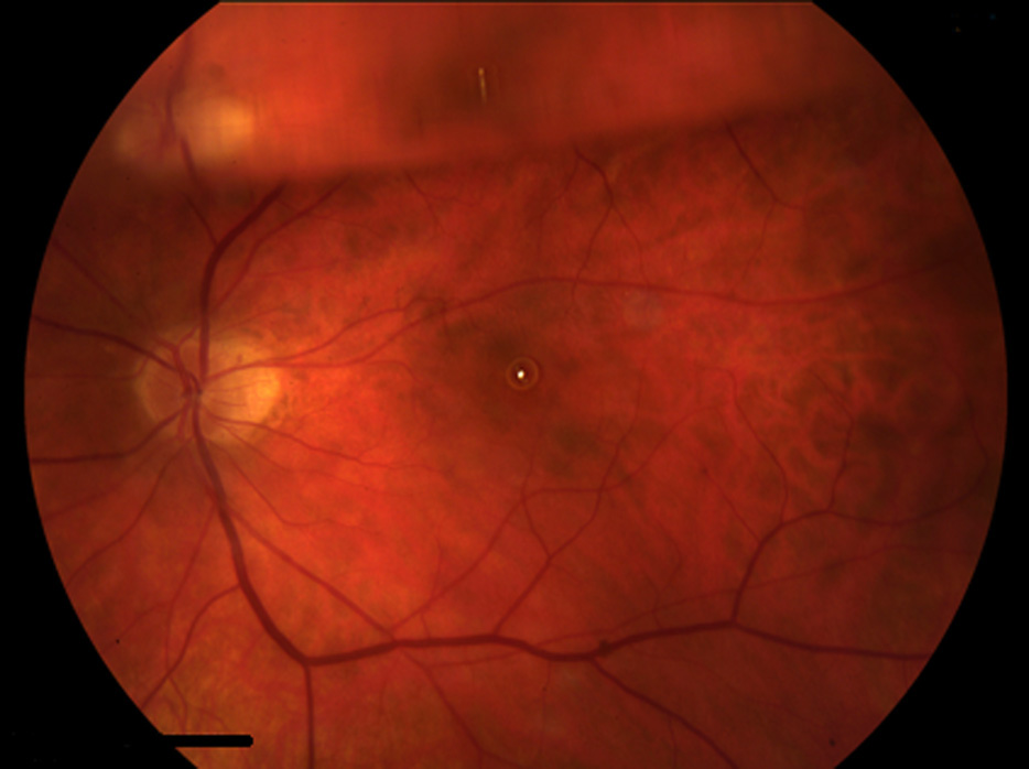 A microbubble of gas as an early indication of macular hole formation after vitrectomy surgery for retinal detachment repair
