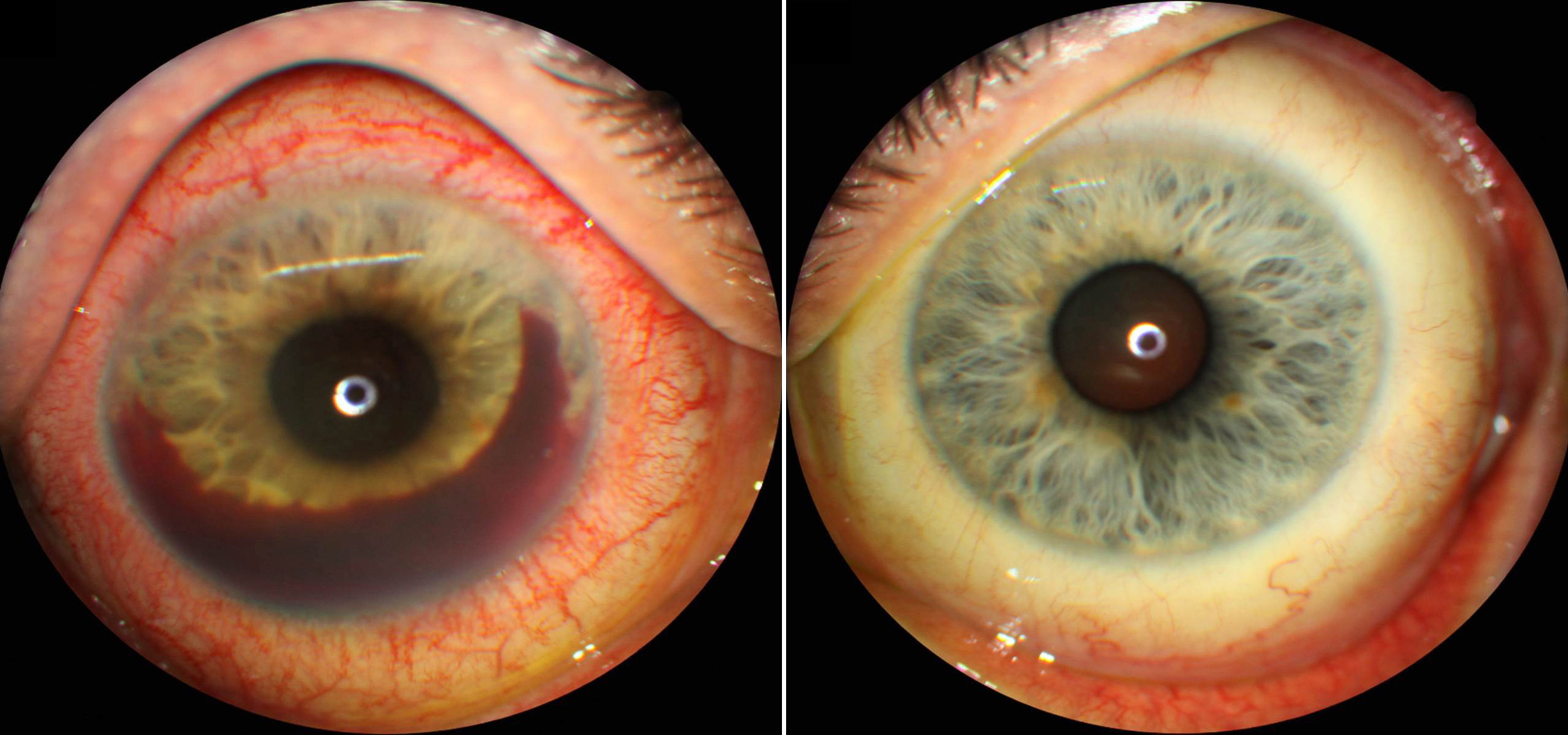 A 45-year-old man with spontaneous hyphema of the right eye