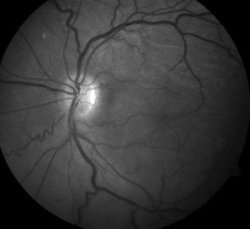 A 61-year-old man with cystoid macular edema and chorioretinal folds after cataract surgery