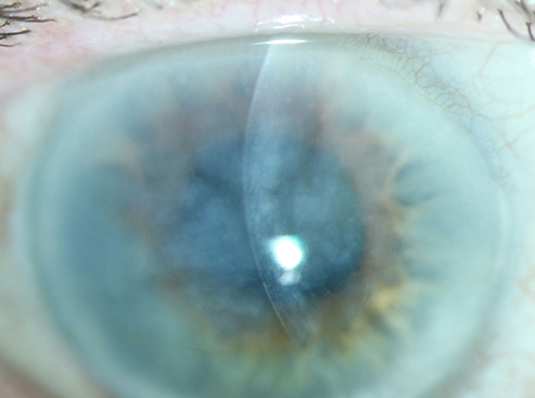 Anterior segment photograph of the right eye demonstrating an edematous and opacified cornea without keratic precipitates