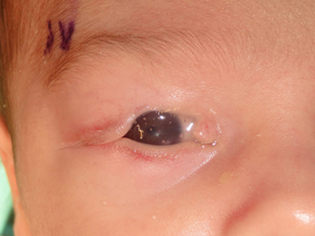 A 5-day-old-newborn with a large right upper eyelid coloboma
