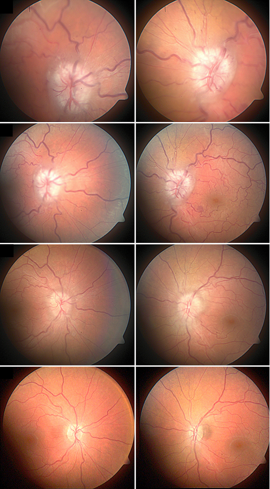 A 24-year-old woman with rapidly progressing vision loss