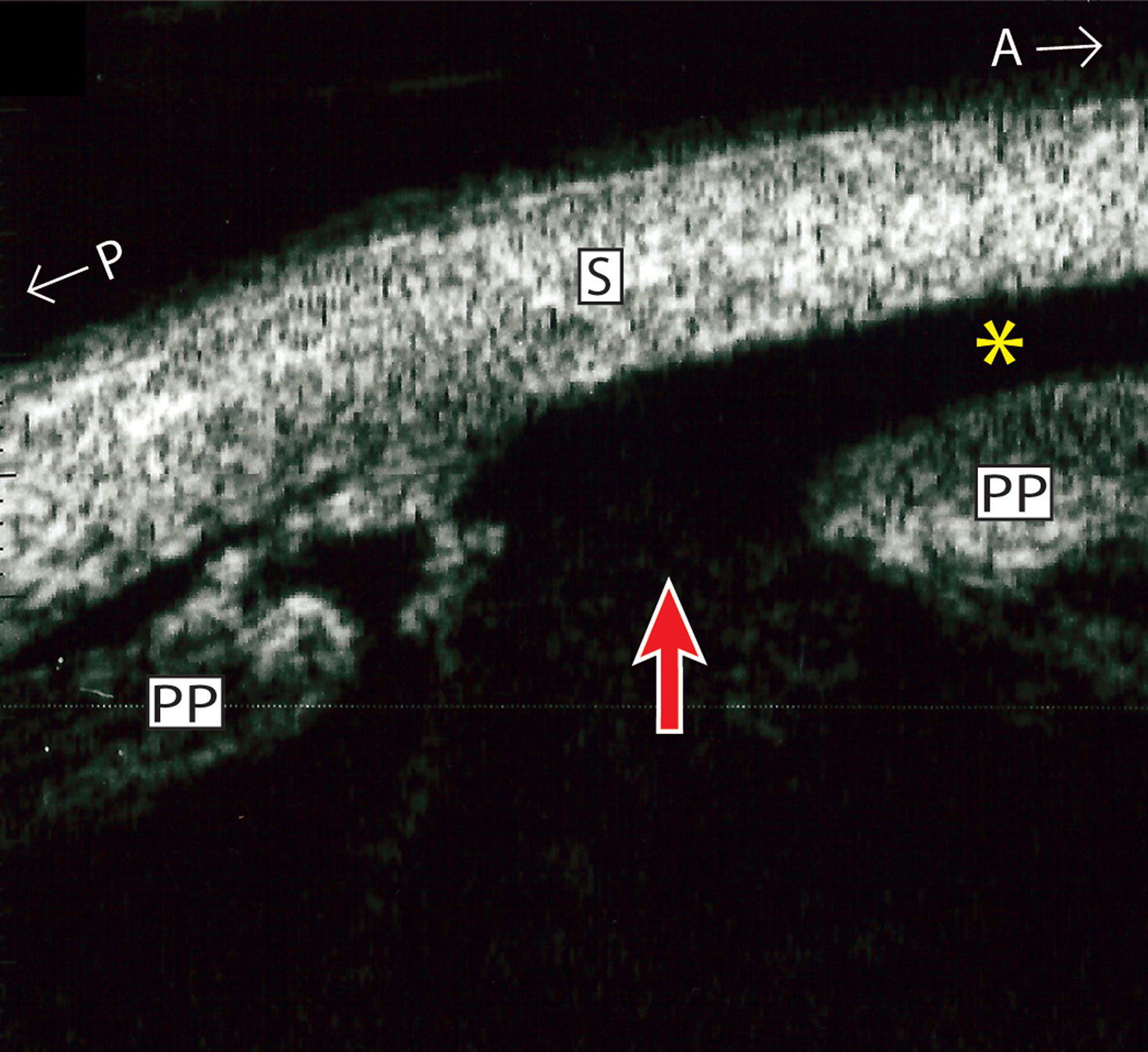 A 66-year-old woman referred for vitreous hemorrhage after cannula dislodgement during cataract surgery wound hydration. A, Transverse B-scan at 7:00 detected a tissue abnormality anteriorly (red arrow). B-C, Ultrasound biomicroscopy revealed rupture of the pars plana (red arrow) and subuveal fluid tracking anteriorly (asterisks) at 7:00. D, The lens haptic remains well-positioned (black arrow).