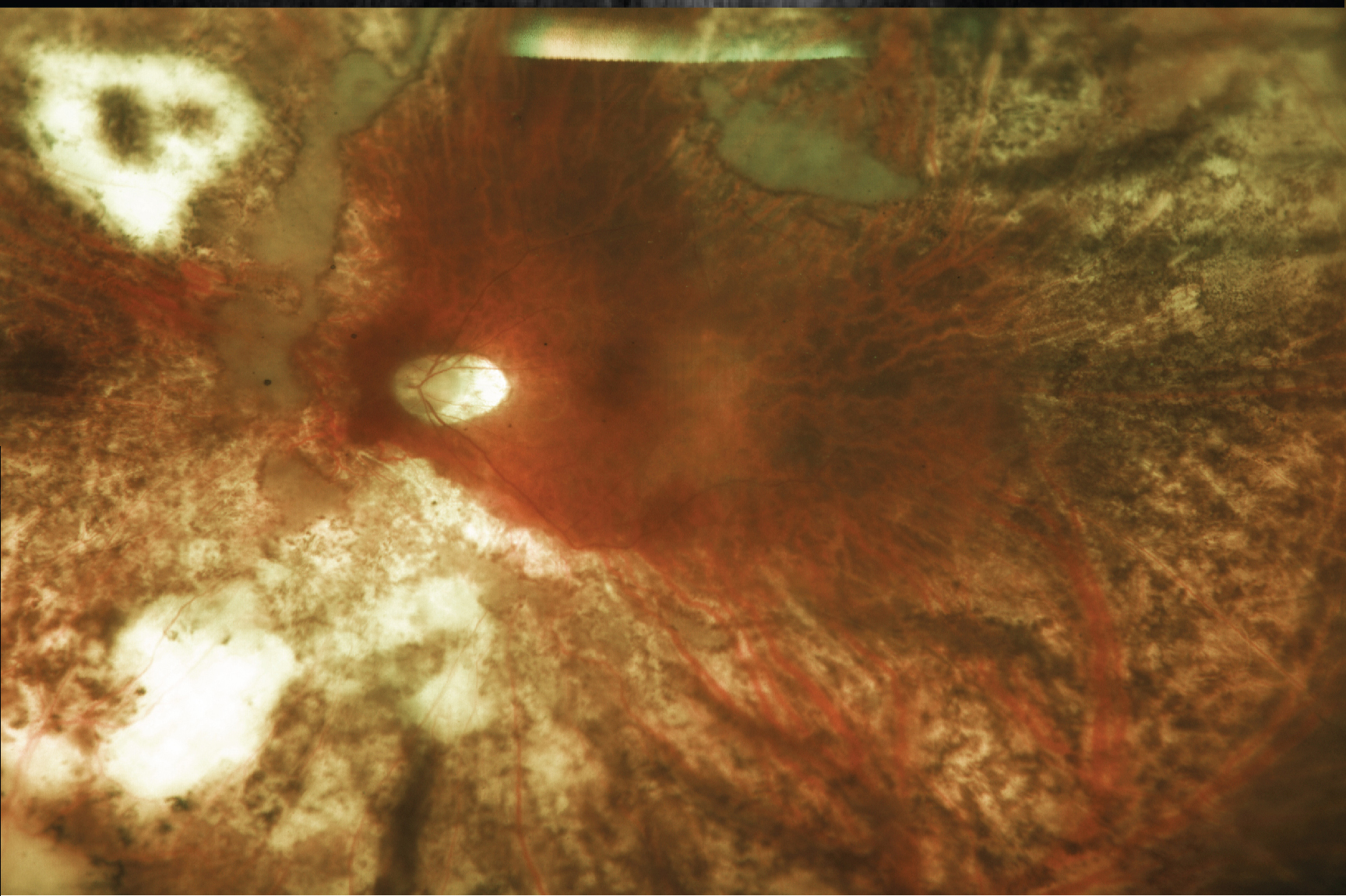 Stalagmite-like preretinal deposits in a vitrectomized eye with intraocular lymphoma