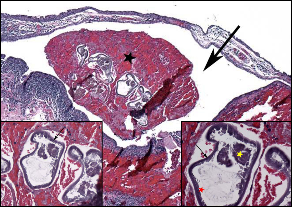 A 64-year-old man with an unusual conjunctival cyst