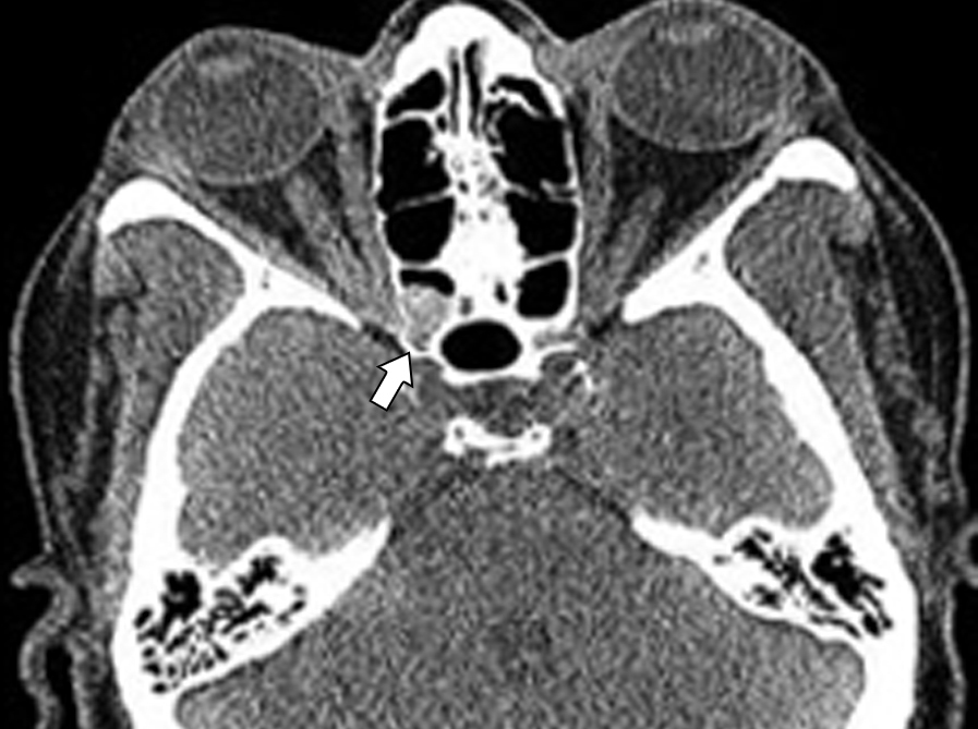 An erosive lesion in the orbital apex as the presenting sign of sarcoidosis
