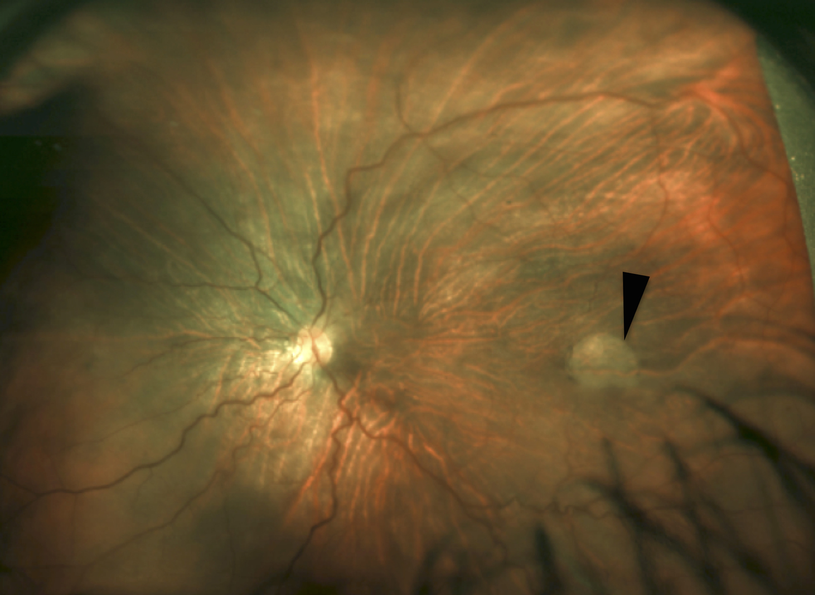 Optical coherence tomography findings and successful repair of retina detachment in Knobloch syndrome