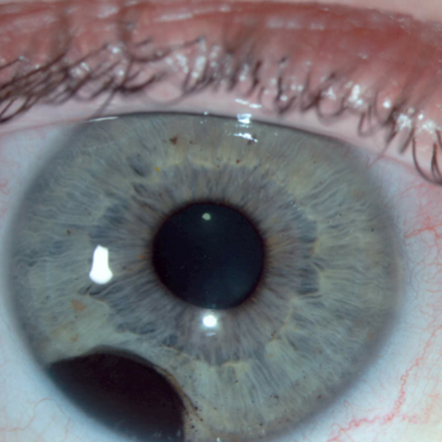 Uveal melanoma with BAP1 mutation