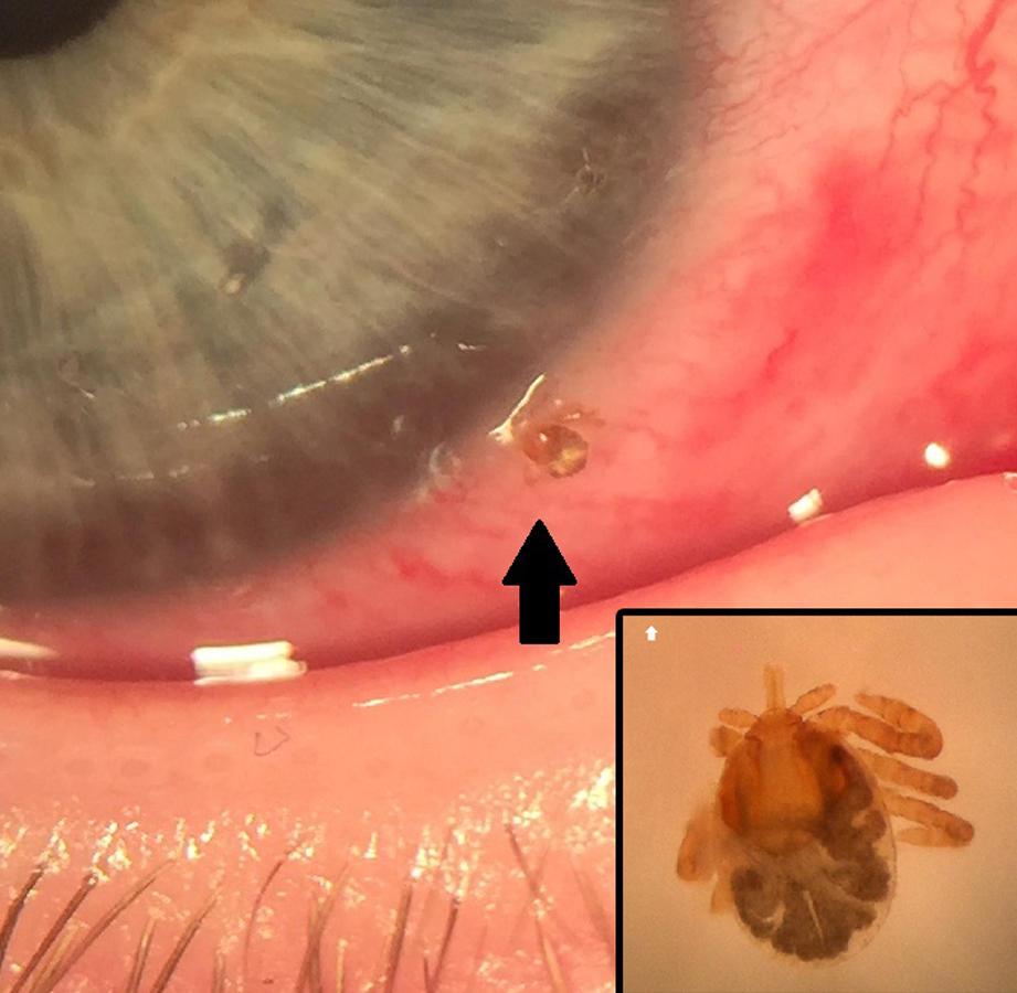 Conjunctival tick bite