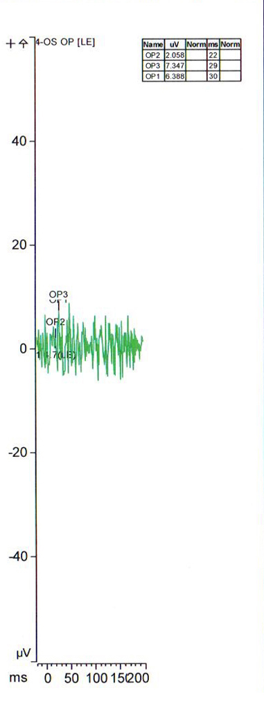 A 71-year-old woman with decreased vision, nyctalopia, and peripheral vision loss