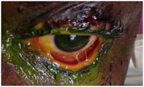 Ocular complications after adverse reaction to phenytoin