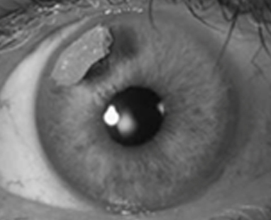 Review of select glaucoma case reports published in 2015