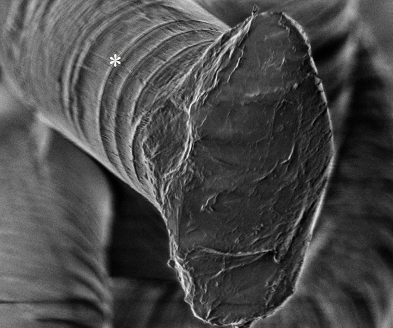 Report of a 10-0 polypropylene suture that did not undergo biodegradation after 13 years in the eye