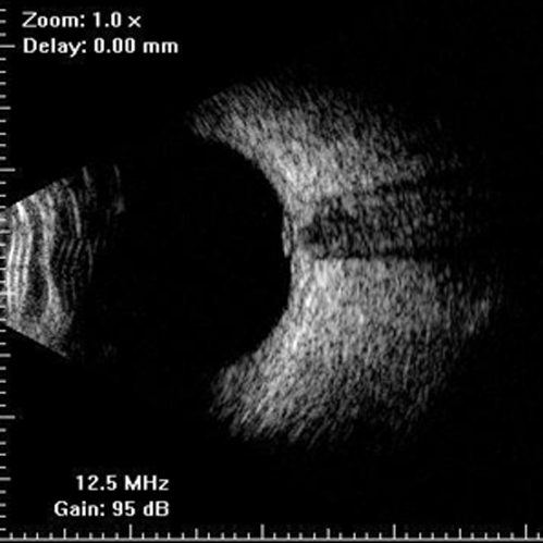 Ultrasound of the right eye showing the optic disc swelling