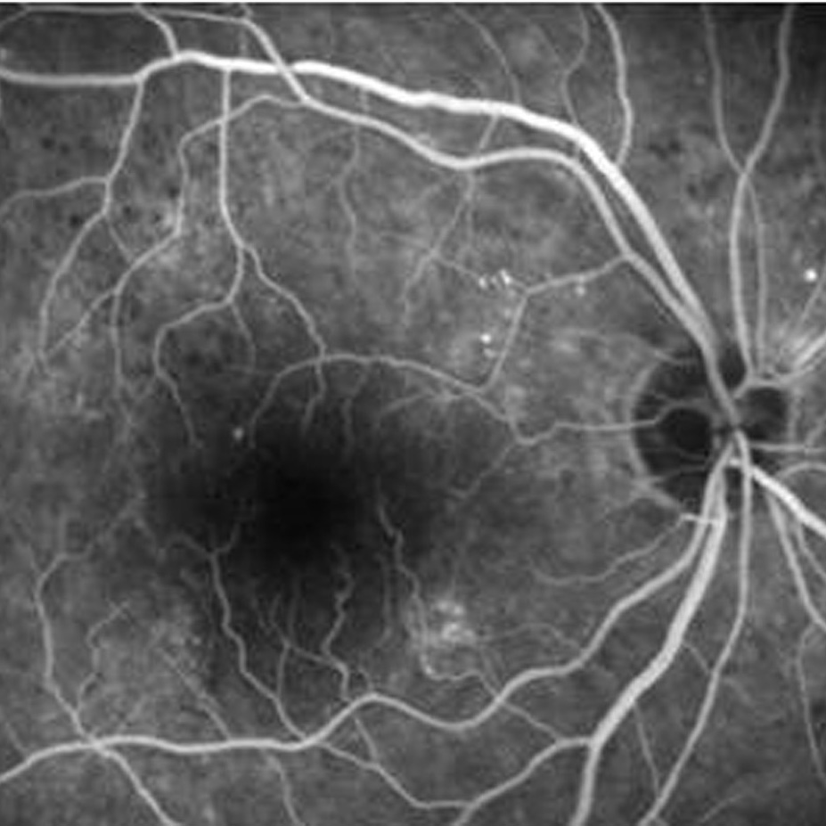 Representative patient treated with one combined treatment of bevacizumab and photodynamic therapy.